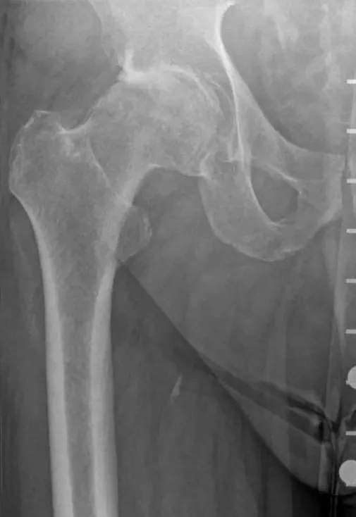 Arthritic Xray Hip