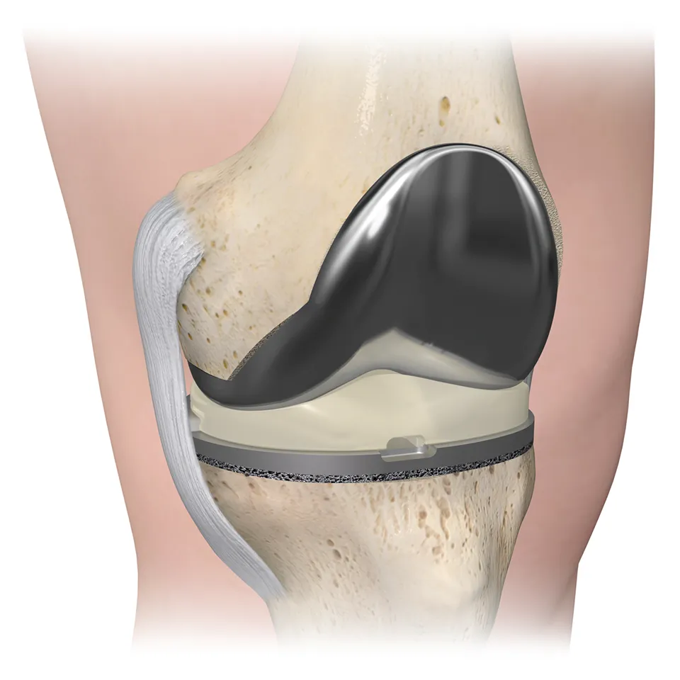 Persona in bone with skin extension
