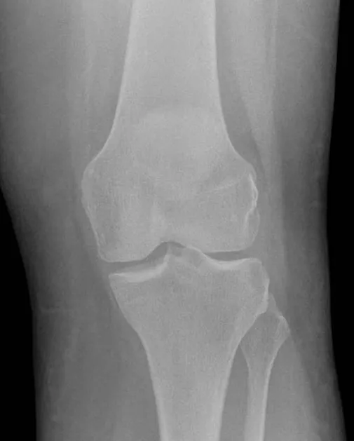 Normal Knee