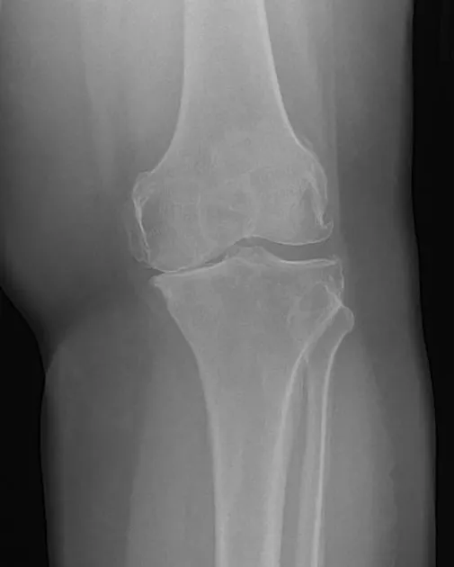 Total Knee Replacement OA Xray